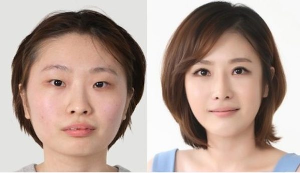As cirurgias plásticas mais extremas da Coreia do Sul