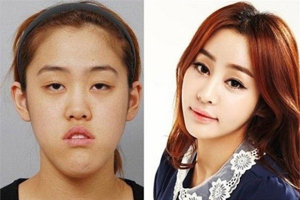 As cirurgias plásticas mais extremas da Coreia do Sul